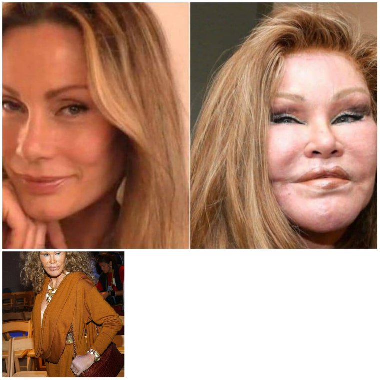 Джослин Вильденштейн до до пластики