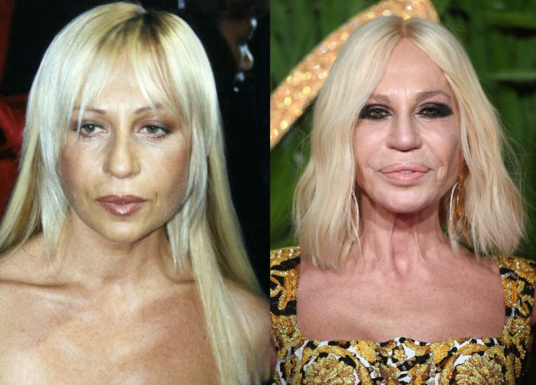 Donatella Versace до пластики