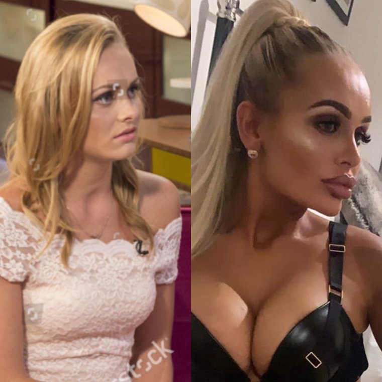 Люди переборщившие с пластикой