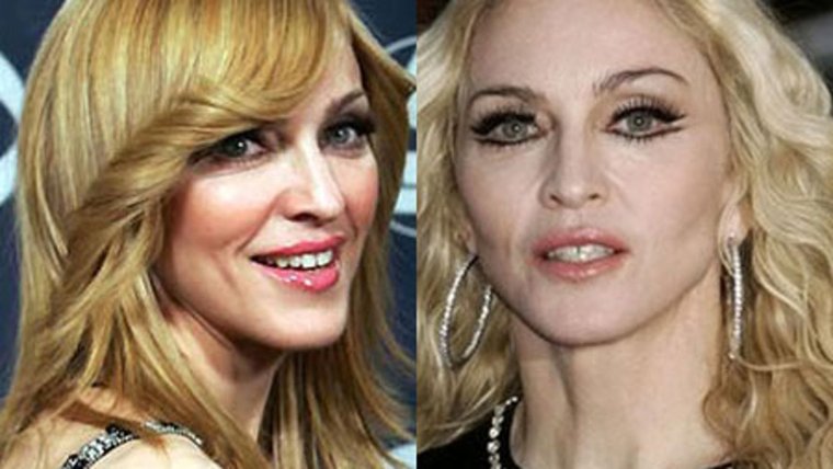 Мадонна пластические операции