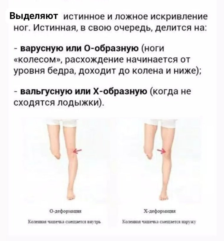 Упражнения для коррекции кривых ног