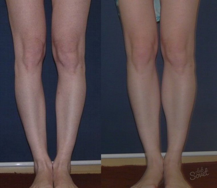 О образное искривление ног