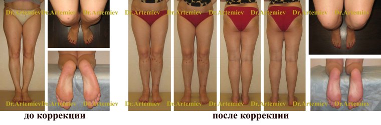 Исправления Икс образных ног