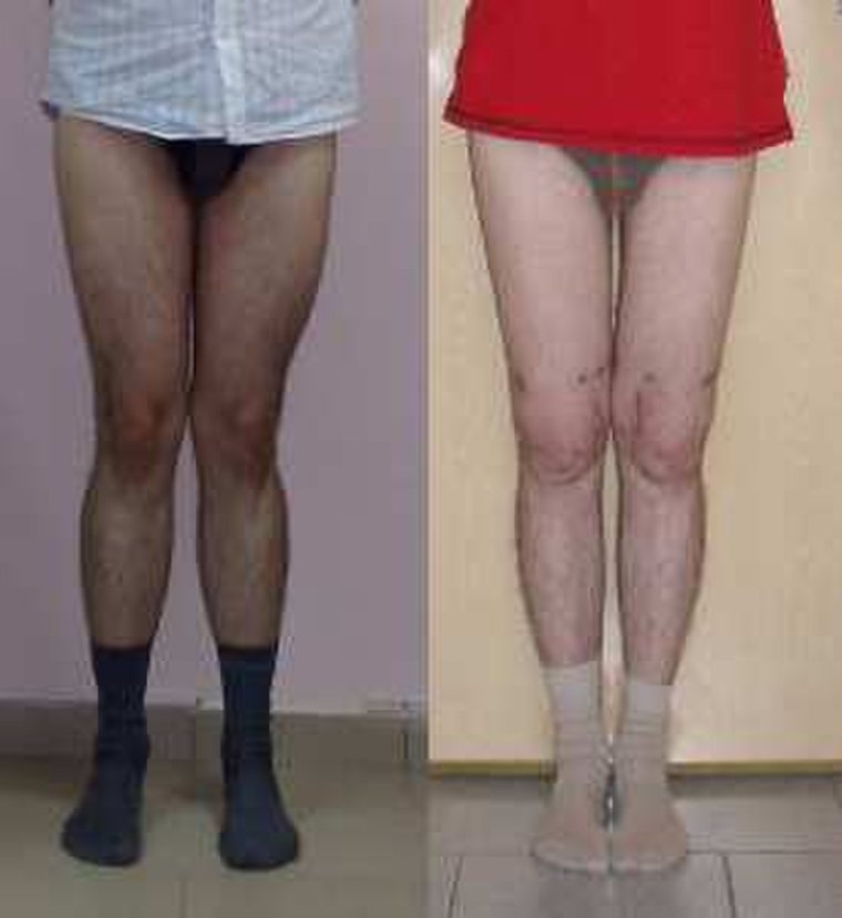 Х образное искривление ног