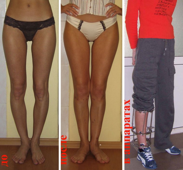 Ровные ноги