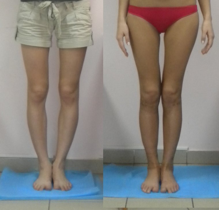 Аппарат Илизарова исправление кривизны ног