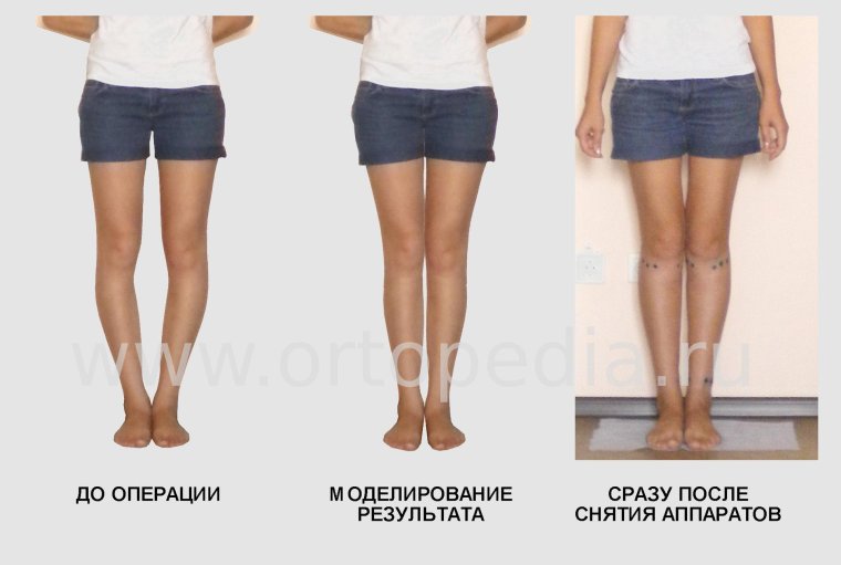 Выпрямить ноги без операции