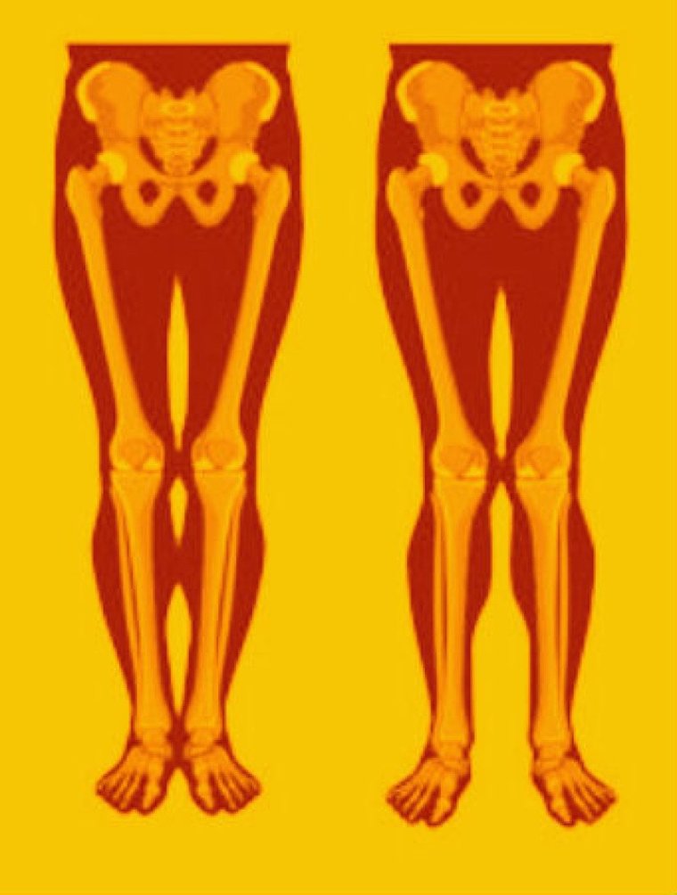 Варусная деформация голени