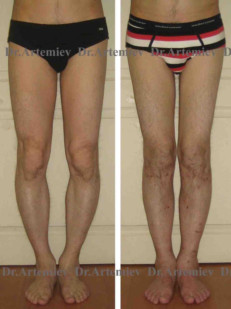 Вальгусная деформация голени (х-образные ноги).