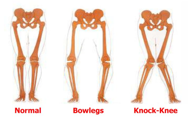 Варусная деформация коленных суставов
