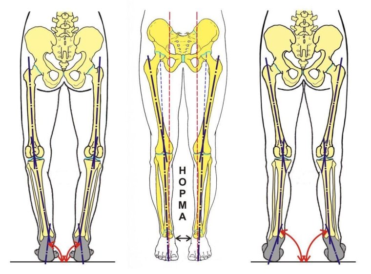 Варусная деформация оси нижних конечностей