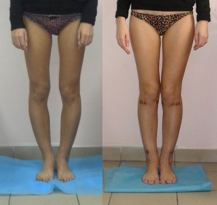 Х образная деформация ног