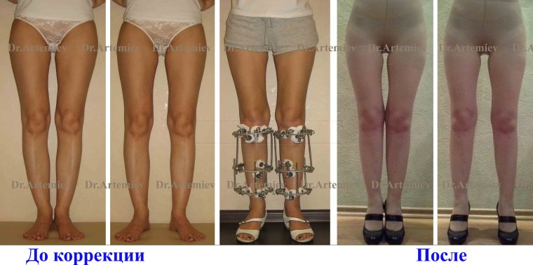 О образная кривизна ног