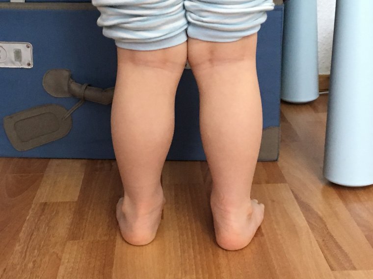 Вальгусная дисплазия голени