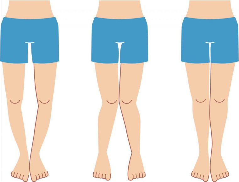 Икс-образные ноги вальгус