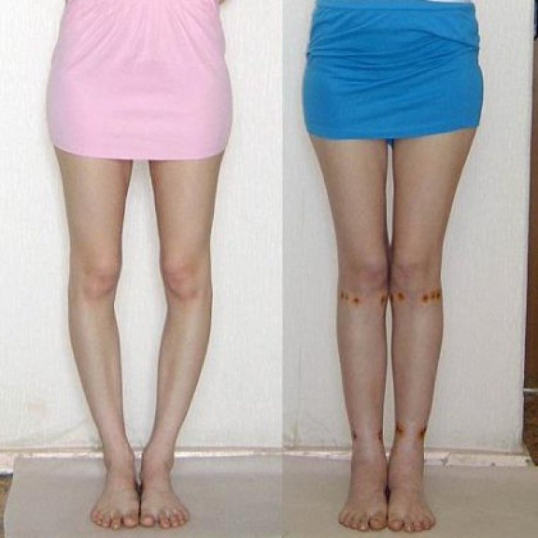 Кривые ноги у девушек