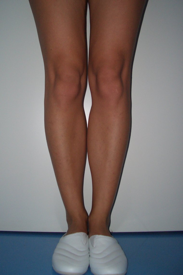 О образная кривизна ног