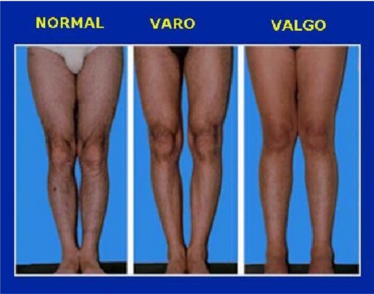 Эквино вальгусная деформация стопы