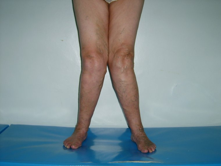 Икс образные ноги у ребенка