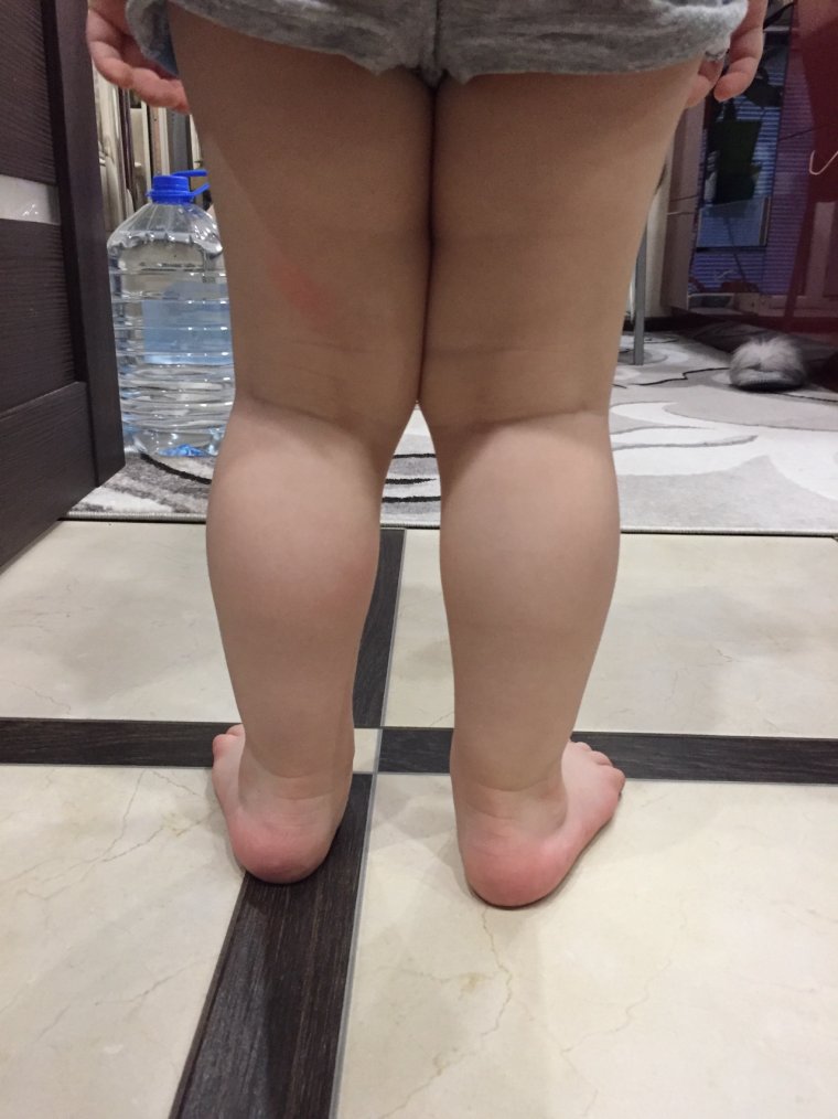 Кривые ножки у ребенка 2 года