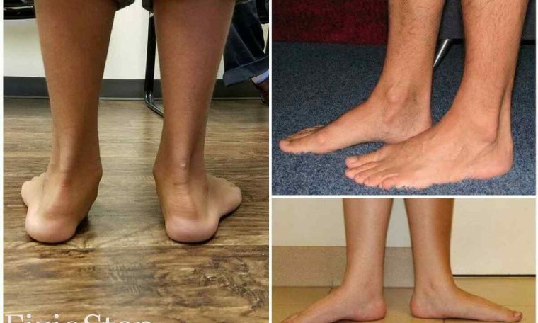 Х-образные ноги у ребенка 2 лет