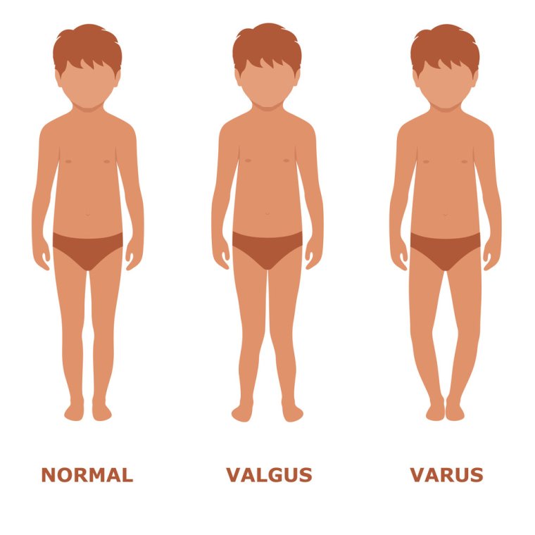 Варусная деформация колена
