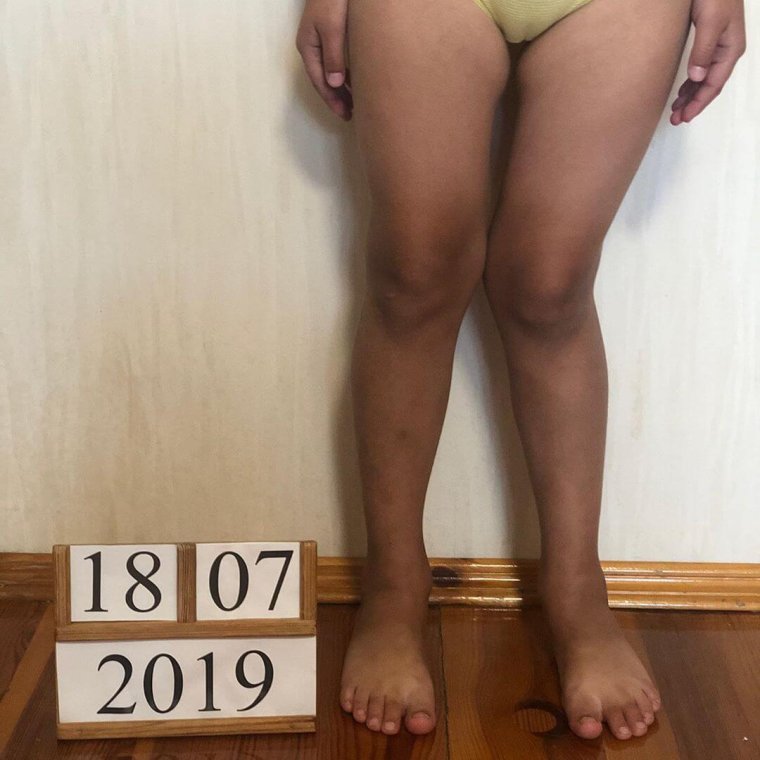 Ножки иксом у ребенка 3