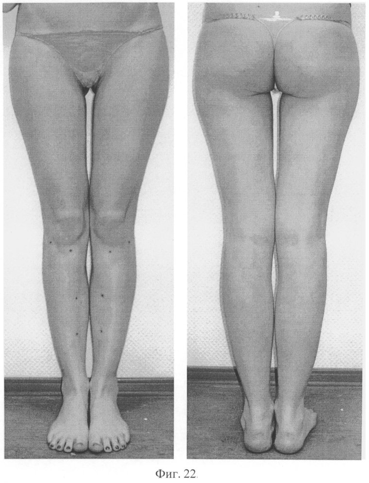 Варусная деформация коленных