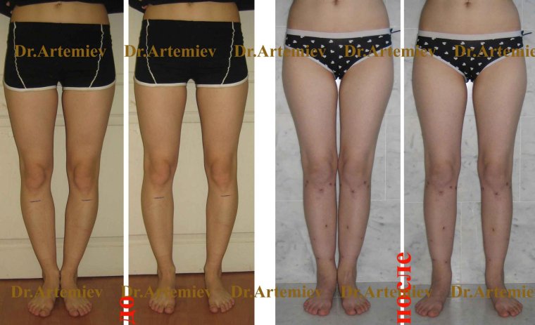 Плоскостопие деформация стопы