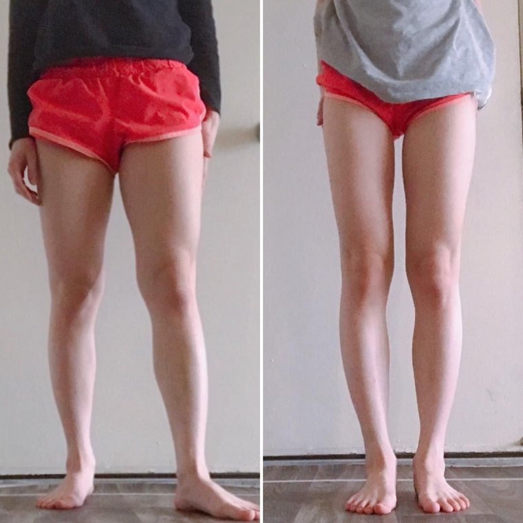 Х-образные ноги у девушек