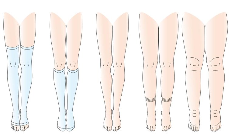 Аппарат Илизарова вальгусная