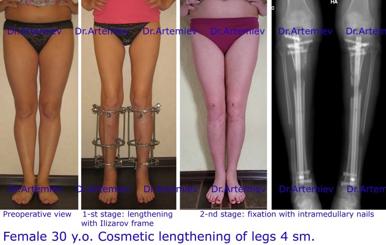 Деформация стоп у балерин вальгусная