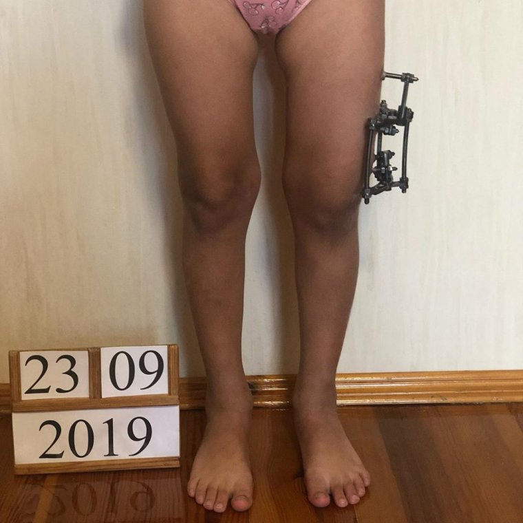 О образное искривление ног у ребенка