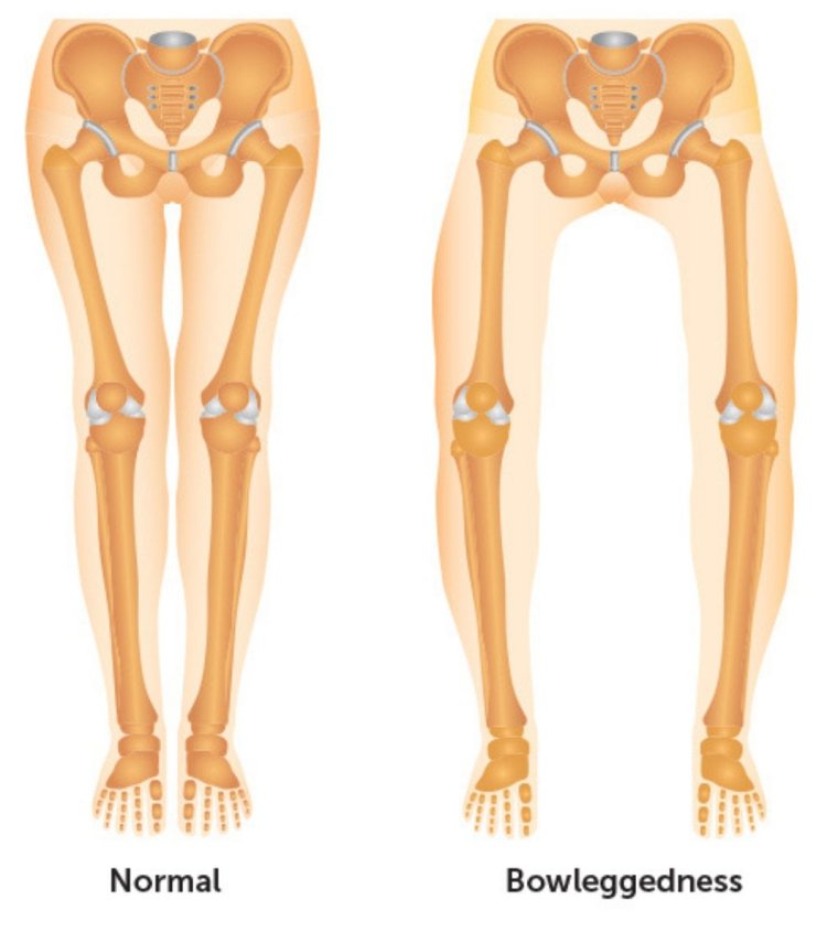 Кривые женские ноги