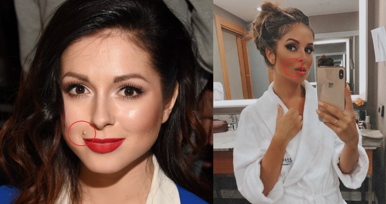 Жасмин ринопластика