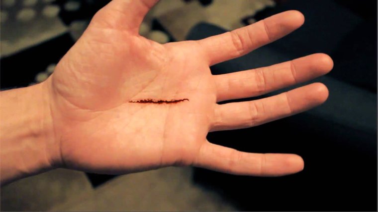 Стенозирующий лигаментит де Кервена