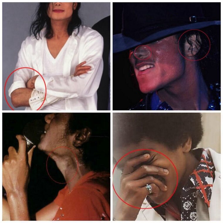 Майкл Джексон витилиго