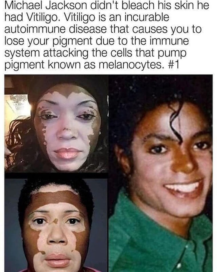 Майкл Джексон витилиго без грима