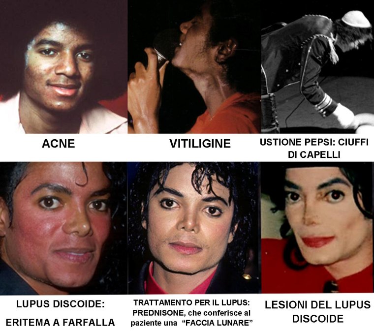 Люпус у Майкла Джексона