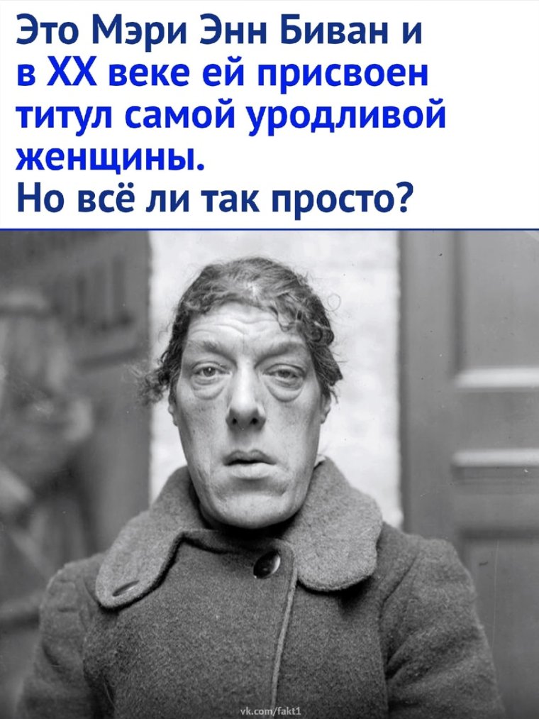 Акромегалия Мэри Энн Беван