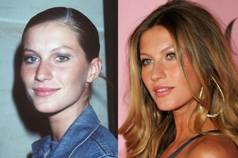 Ринопластика Жизель Бундхен