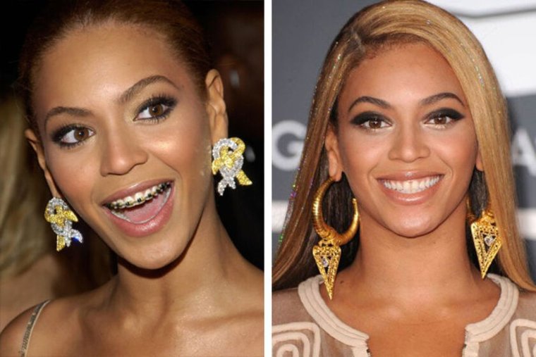 Звезды в брекетах до и после