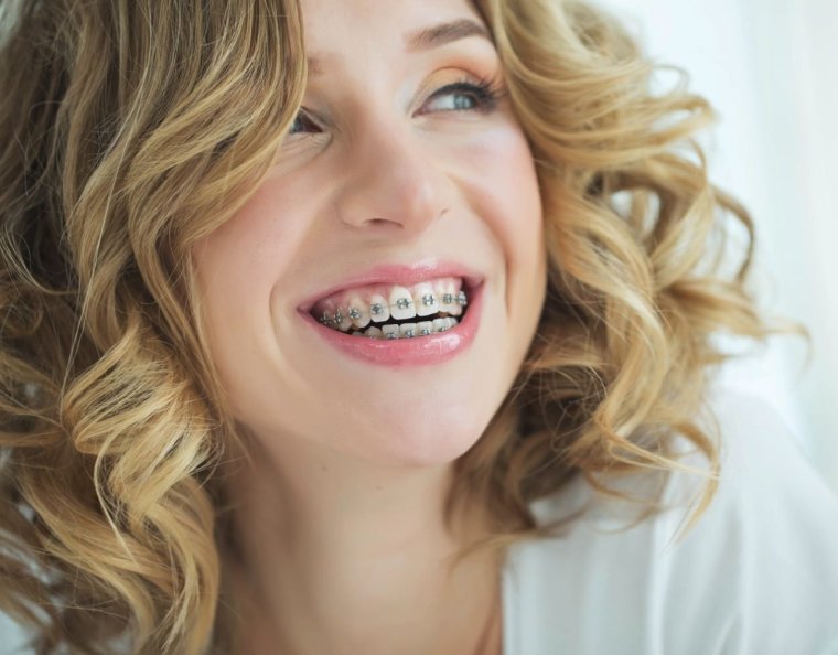 Красивые девушки с брекетами
