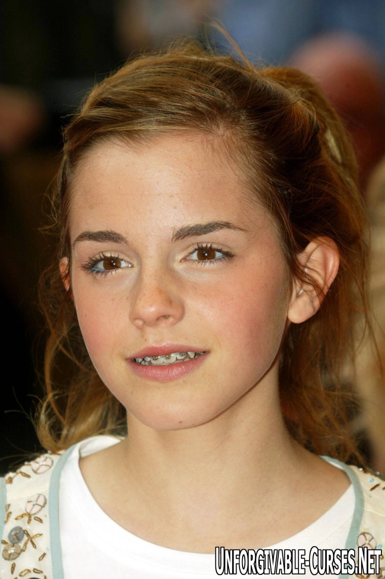 Эмма Уотсон с брекетами