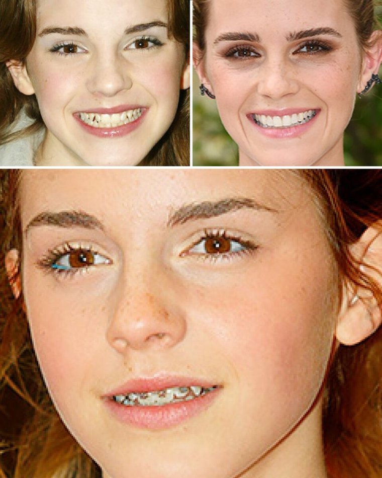 Эмма Уотсон с брекетами