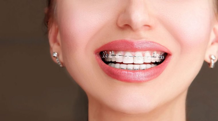 Пластиковые брекеты