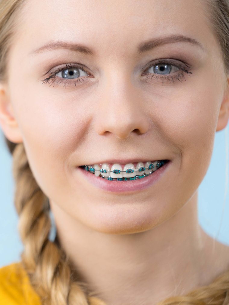 Брекет система