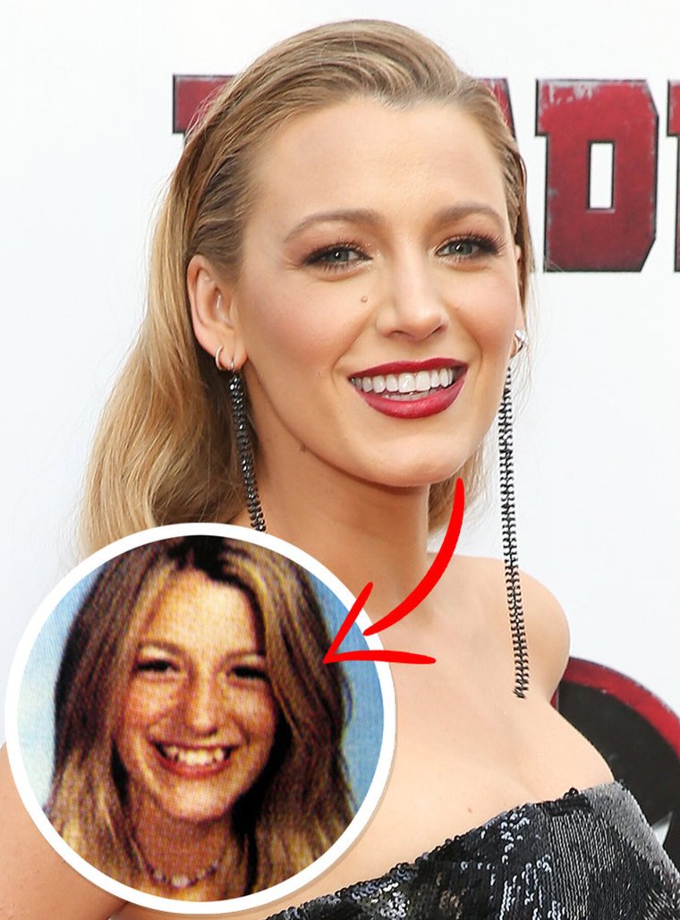 Блейк Лайвли зубы до и после