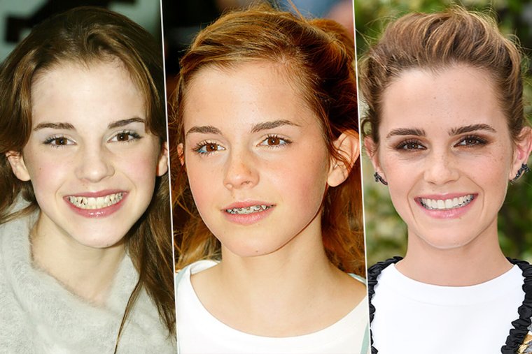 Синди Кроуфорд с брекетами