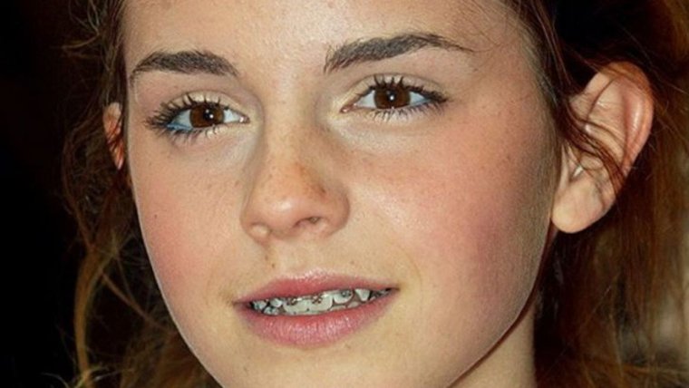 Эмма Уотсон с брекетами
